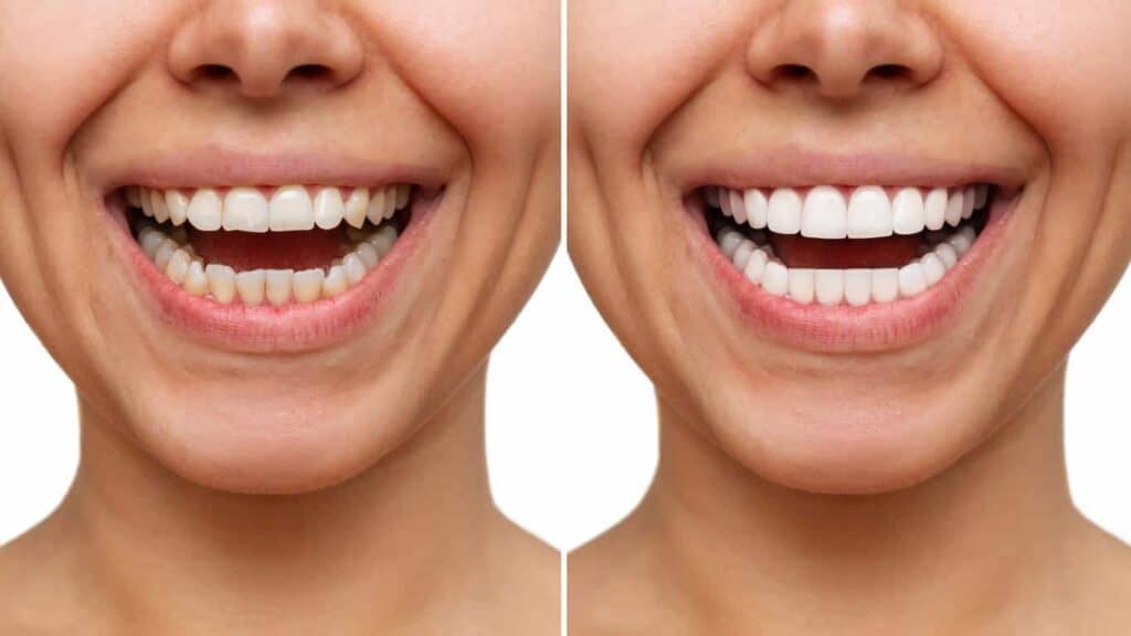 Contact Aspire White for teeth whitening services – Get in touch with Grimsby today