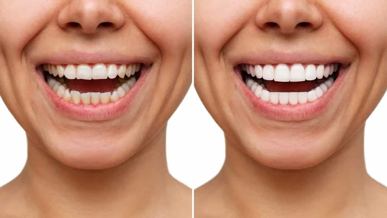 Contact Aspire White for teeth whitening services – Get in touch with Grimsby today