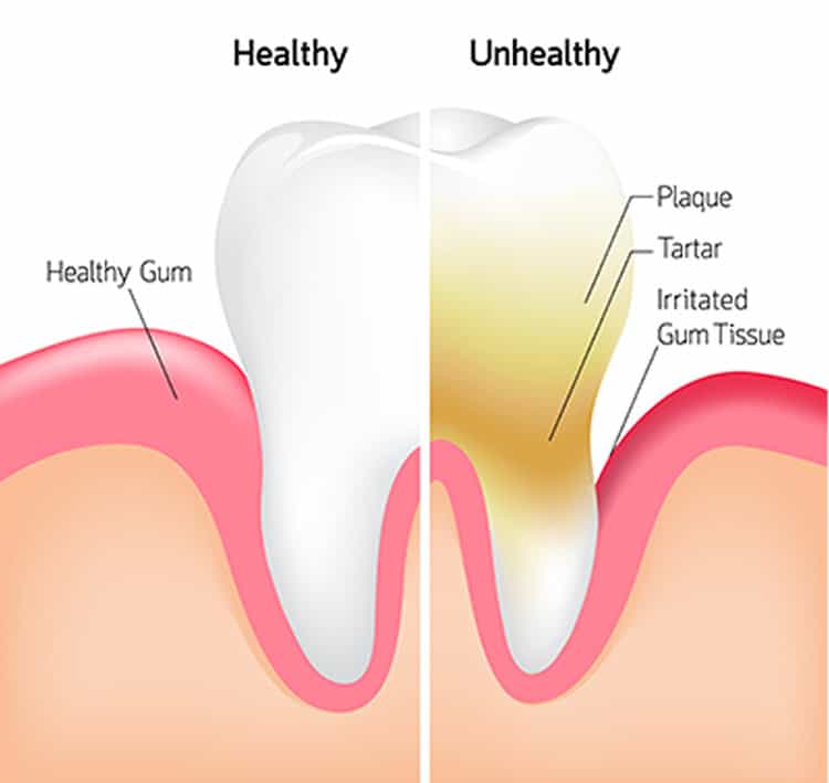 Should you invest in whitening treatments even if your enamel is weak Grimsby