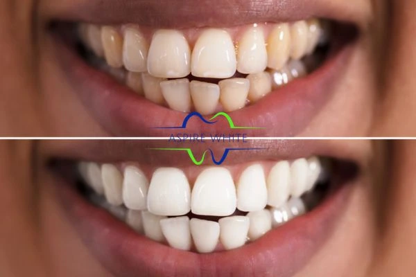 Aspire White customer before and after Grimsby results.