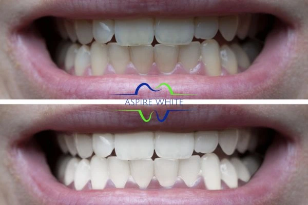 1 hour laser teeth whitening before and after results Grimsby
