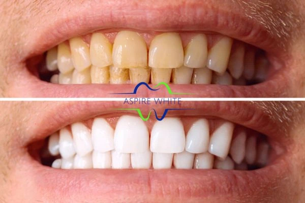 Get noticeable whiter smile in just one hour! Book your teeth whitening treatment Grimsby today!