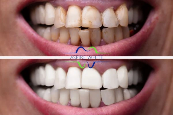 Before and after results of laser teeth whitening Grimsby Book in online today!