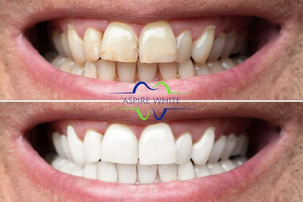 Achieve a radiant smile with professional laser teeth whitening Grimsby